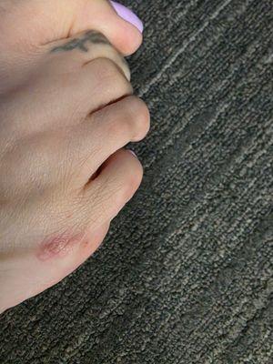 Ringworm from Royal Nails in Brentwood on Lone Tree Way.