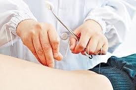 Acupuncture treatment