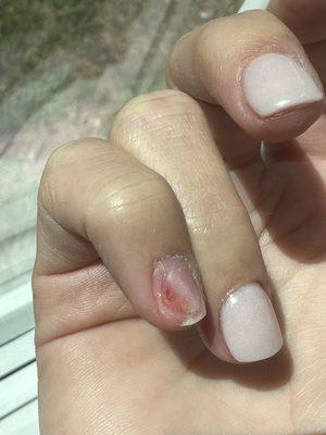 Throbbing cut nail