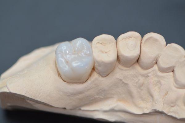 Molar crown upper