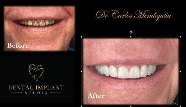 Before and after Smile Design
