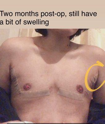 It took around six months for all the swelling to go down completely.