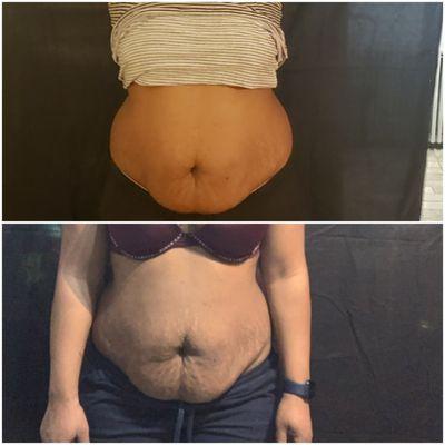 2 sessions of cavi/laser lipo