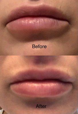 Before and After lip correction with hyaluronic acid dermal filler