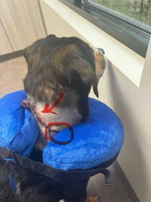 1 inch removal with around the spine incision