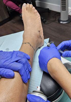 Receiving second round of amniotic stem cells.