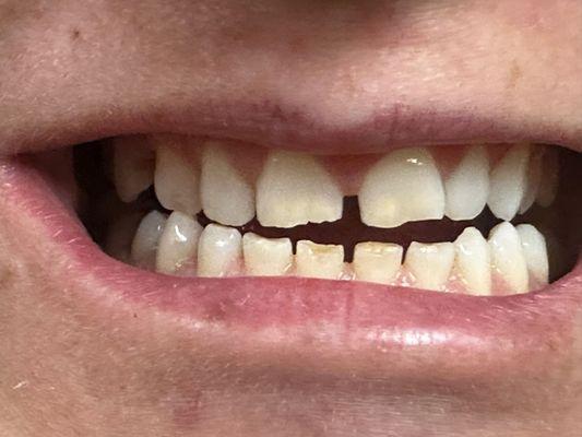 This is my ugly teeth. You see on the top. The bottom is next. But look at the next pictures