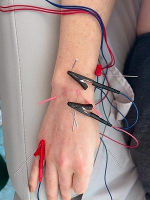 Electro stimulation for healing post wrist surgery.