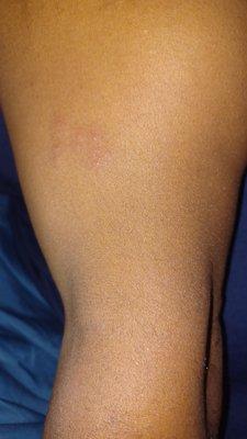 Bedbug bites on my  husband's inner arm.