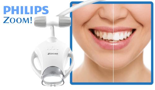 SPECIAL!! 1 hour whitening home kit included only $399