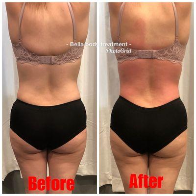 Cavitation and body sculpting treatment first session on her back
