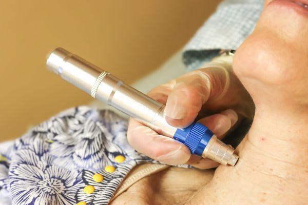 Wellpoint Acupuncture now offers holistic microneedling. No toxic fillers, or topicals. Improve your skin safely and naturally.