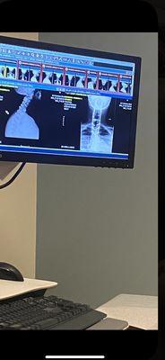 2 rods screws n cage from neck surgery