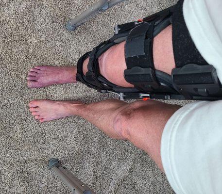 The brace I wore for 12 weeks post op & swelling in my leg. Kathy always made me feel better and helped me thru this recovery 