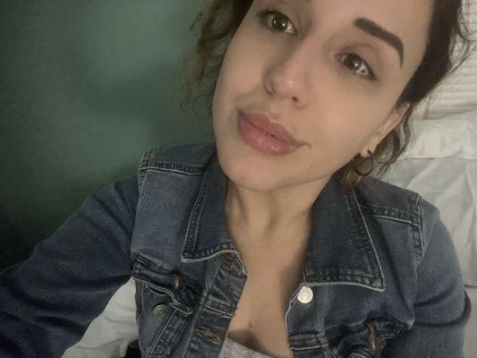 Liquid rhinoplasty from the front