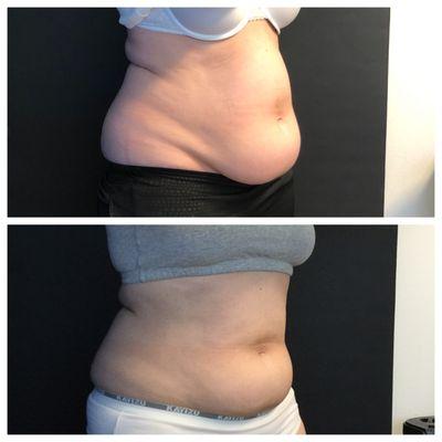 1 lower abdomen treatment. 6 weeks between before & after photos.