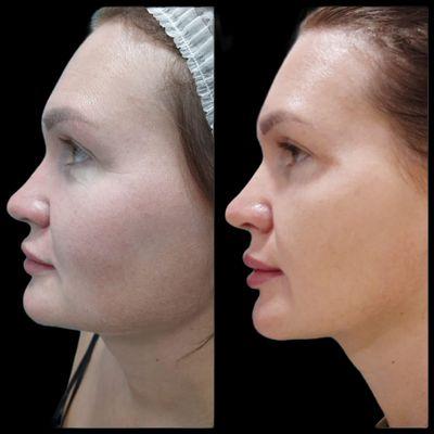 Face massage, face rejuvenating , face lift, non-invasive face lift, NT Plasma, cold plasma