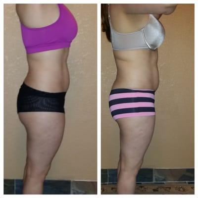 Non-invasive ZERONA laser lipo UltraFit Spa Orlando