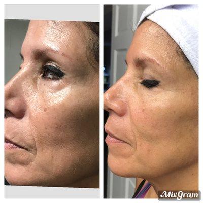 CBD infusion therapy. Includes enzyme peeling follow up with CBD mask. Great results seen right after procedure