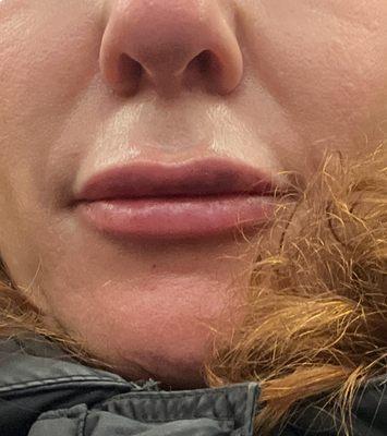 1 day post lip filler - swelling and bruising