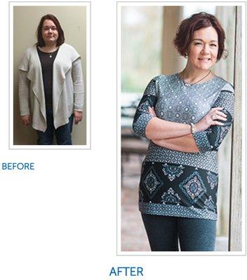 Beth lost 85 pounds with Gastric Sleeve Surgery.