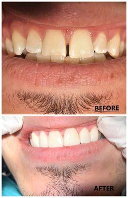 #6-11 Veneers before and after. Pt. wanted to close gaps on brighten smile.