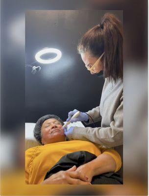 Microneedling
