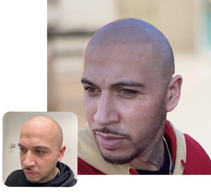 Scalp Micropigmentation