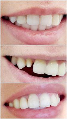 Before, during, and after crown. Can't even tell which one is the crown.