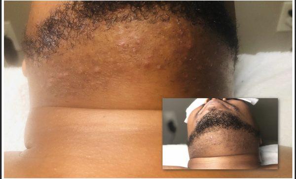 Ingrown hair treatment results