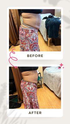 Body sculpting
Cavitation + RF Vacuum Therapy lymphatic rub