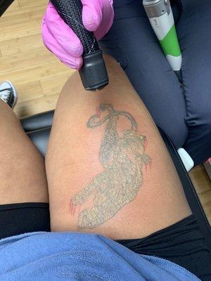 Dtown Laser Tattoo Removal & Aesthetics