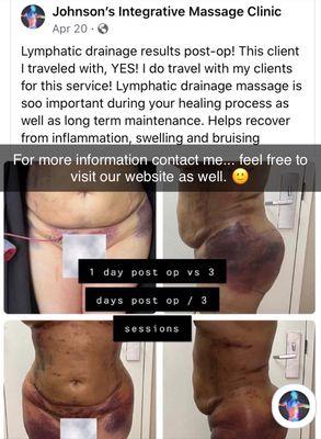 Lymphatic drainage post op BBL