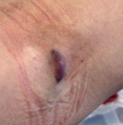 My inner elbow 5 hours after a simple blood draw.