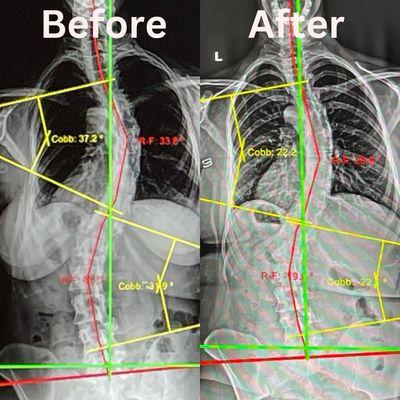 Scoliosis Center of Utah