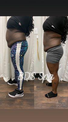 Client used Defined Laser Lipo