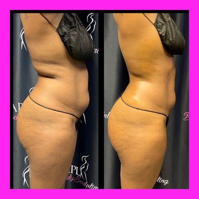 APL Body Sculpting
