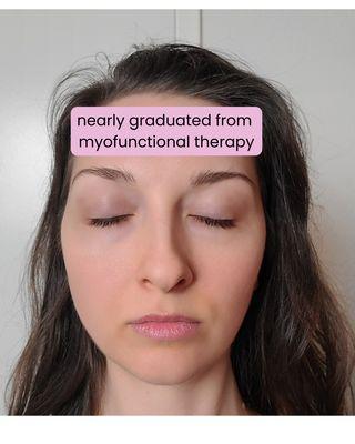 Nearly graduated from myofunctional therapy. Much more symmetry!