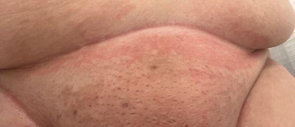 A rash around the entire area of my
