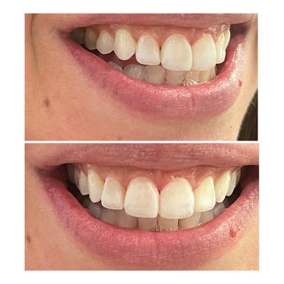 Direct composite Veneer,
PT had spacing between her teeth. Teeth were very small and after braces they could not close the gaps.