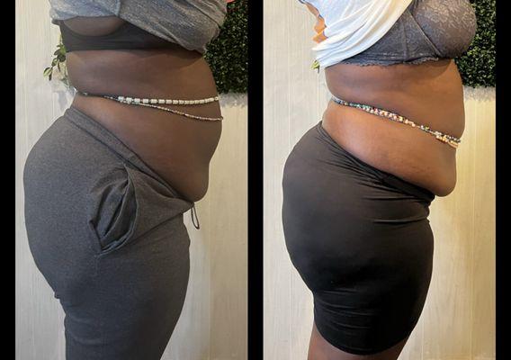 Non-invasive Tummy Makeover