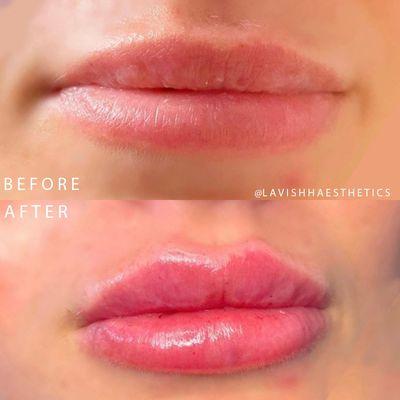 0.5ml Restylane Kysse