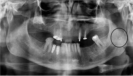 注:
1. 牙齿周围的斑块和钙化,颈动脉分叉处的斑块和钙化,心脏冠状动脉的斑块和钙化,三者有密切相关的正向关系。
2. 颈动脉分叉,在颈椎3与颈椎4之间的高度, 此处最容易出现斑块和钙化。
,