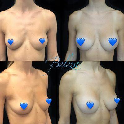 Before & after breast augmentation with silicone gel implants.