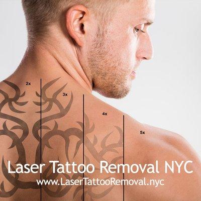 Laser Tattoo Removal - Dermatology