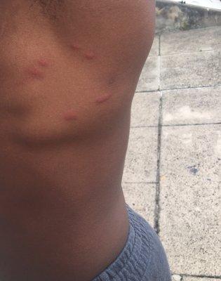 Bedbug bites from mattresses