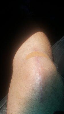 Minimal scarring 3 months after the fact!  NO pain!