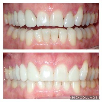 Before and after of front teeth bonding for a more esthetically pleasing look.