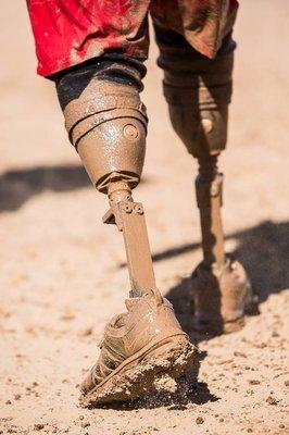 Artificial Limb Specialists