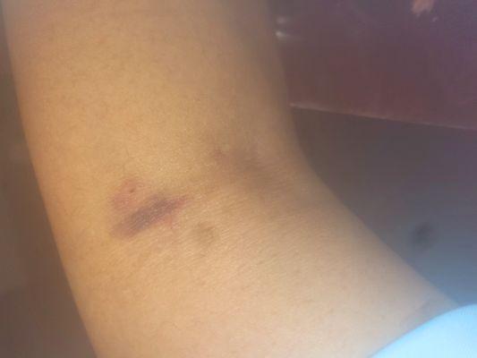 Mis-stick
1st&2nd time in facility